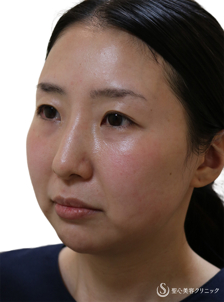 【30代女性・顔のラインを整える】プレミアムPRP皮膚再生療法（額）＋ヒアルロン酸注入（顎）＋ホクロ除去＋Ｎトレチノイン外用（4年5ヶ月後） After 