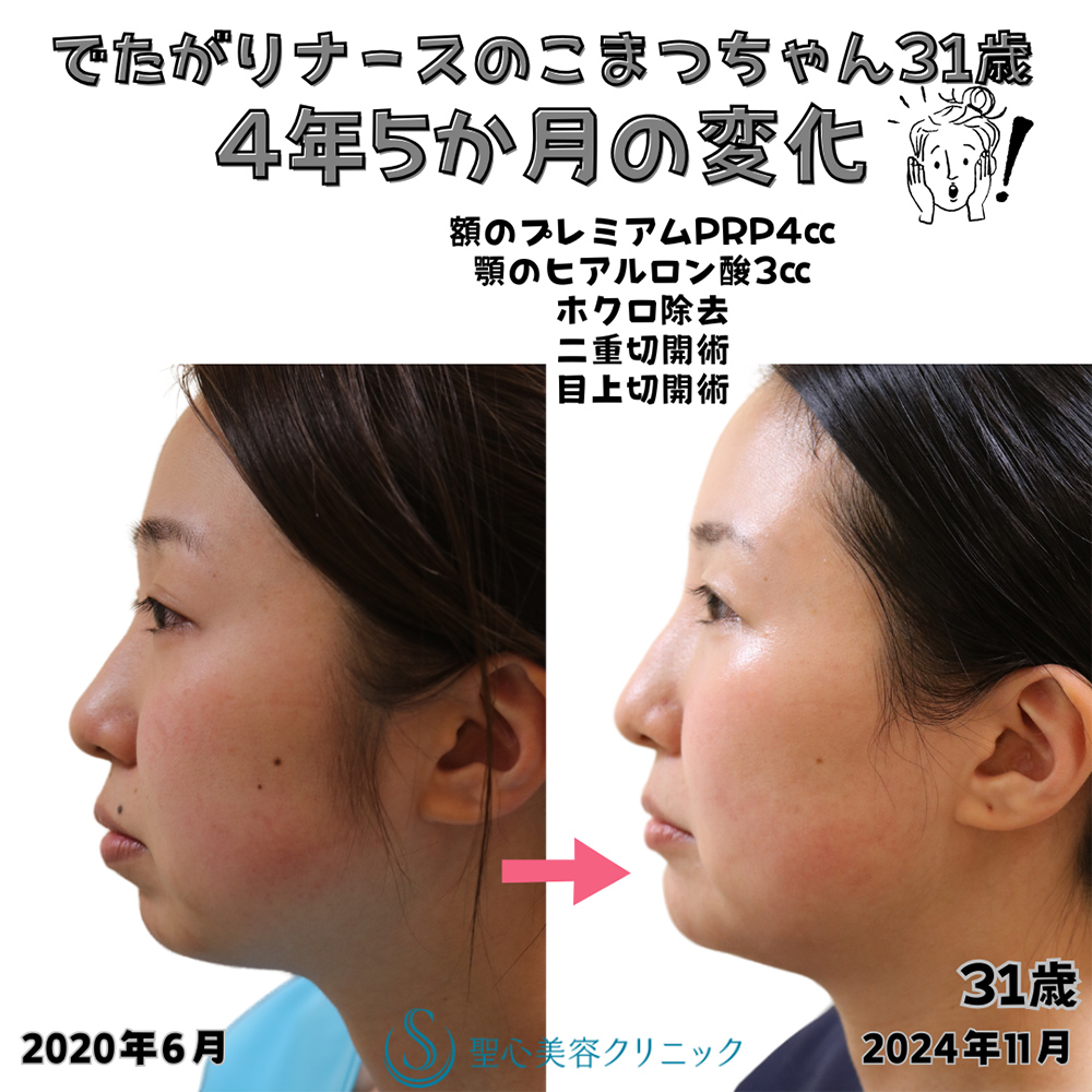 【30代女性・顔のラインを整える】プレミアムPRP皮膚再生療法（額）＋ヒアルロン酸注入（顎）＋ホクロ除去＋Ｎトレチノイン外用（4年5ヶ月後） After 