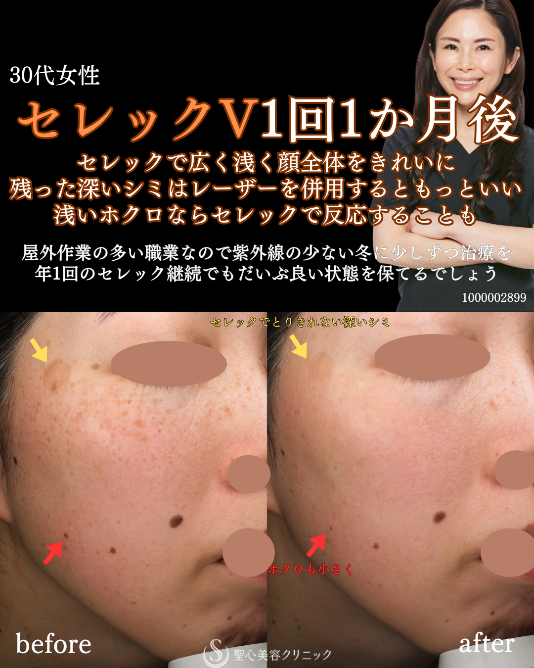 【30代女性・顔のシミ】CellecV（セレックV）（1ヶ月後） After 