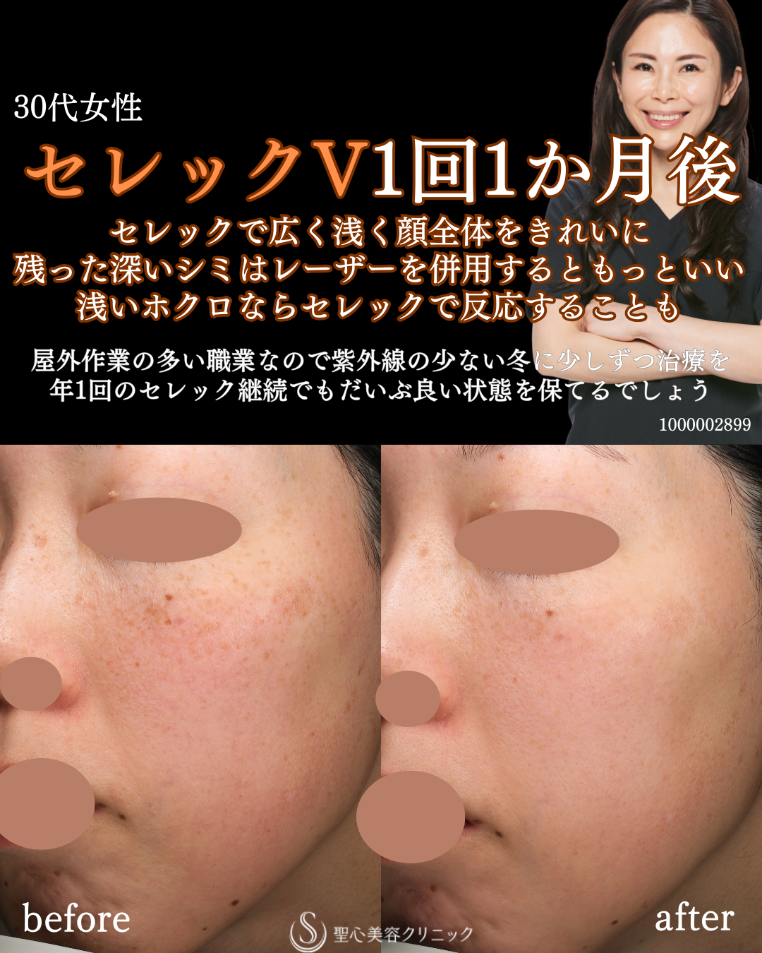 【30代女性・顔のシミ】CellecV（セレックV）（1ヶ月後） After 