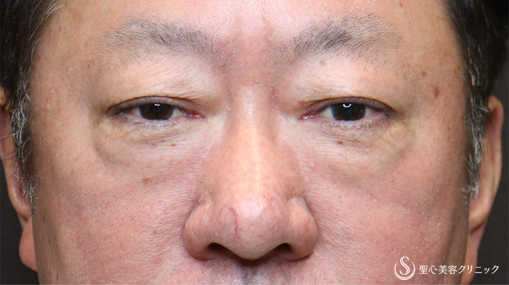 【60代男性・目の下のたるみをスッキリ】下眼瞼除皺術＋目の下のたるみ取り＋脂肪切除（3ヶ月後） Before 