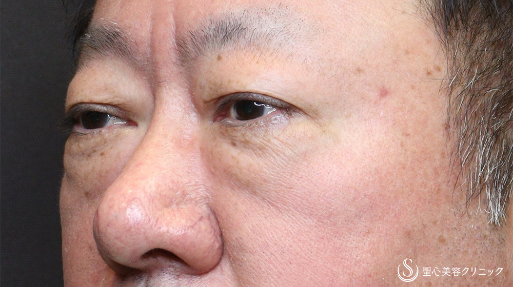 【60代男性・目の下のたるみをスッキリ】下眼瞼除皺術＋目の下のたるみ取り＋脂肪切除（3ヶ月後） Before 