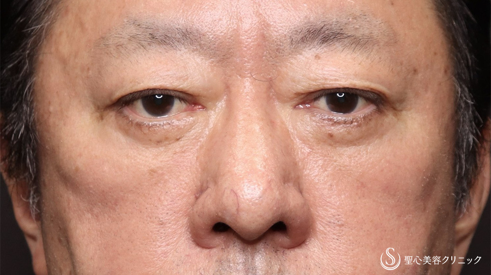 【60代男性・目の下のたるみをスッキリ】下眼瞼除皺術＋目の下のたるみ取り＋脂肪切除（3ヶ月後） After 