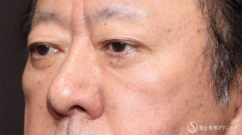 【60代男性・目の下のたるみをスッキリ】下眼瞼除皺術＋目の下のたるみ取り＋脂肪切除（3ヶ月後） After 