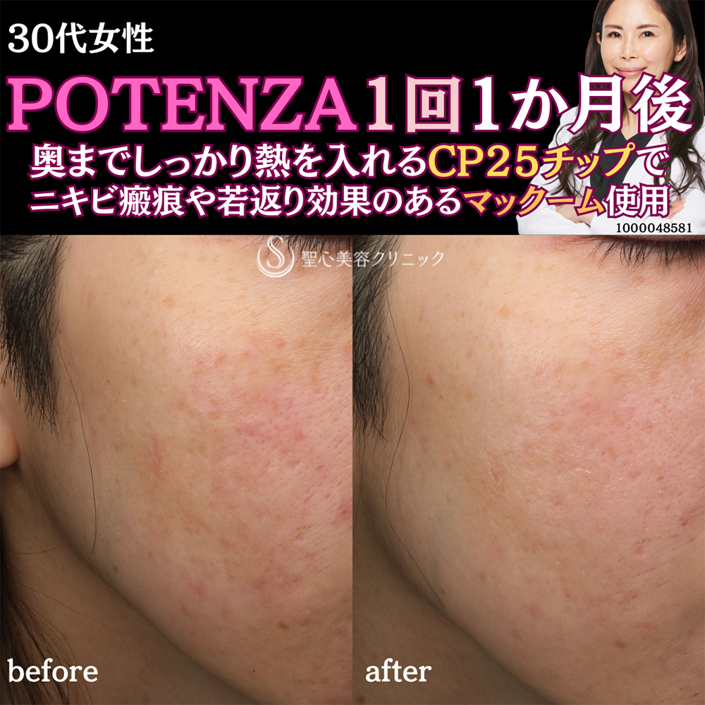 【30代女性・ニキビ痕赤み】POTENZA（ポテンツァ）1回マックーム使用（CP25チップ）（1ヶ月後） After 