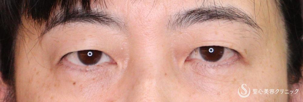 【50代女性・まぶたのたるみ解消】埋没法3点留め（1ヶ月後） Before 