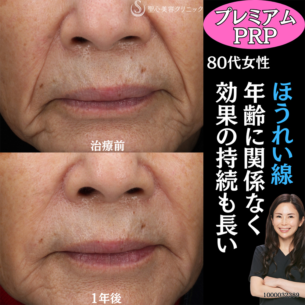 【80代女性・ほうれい線】プレミアムPRP皮膚再生療法（1年後） After 