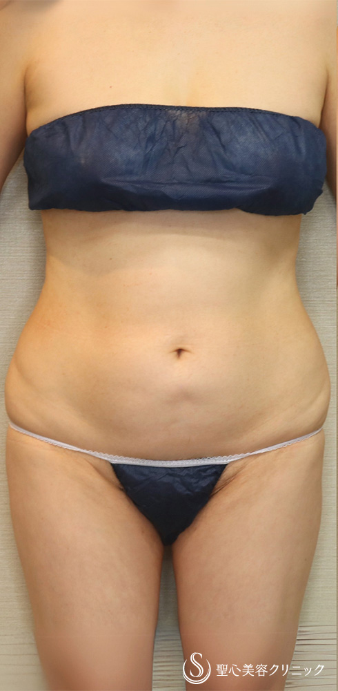 【50代女性・ぽっこりお腹を自然にサイズダウン】脂肪吸引（腹部全周）（4ヶ月後） Before 