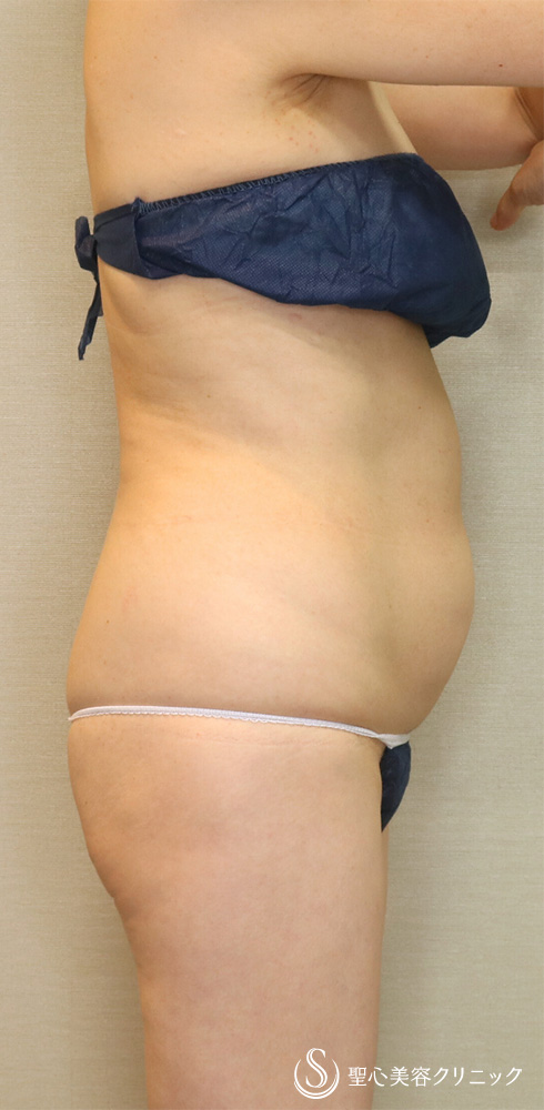 【50代女性・ぽっこりお腹を自然にサイズダウン】脂肪吸引（腹部全周）（4ヶ月後） Before 