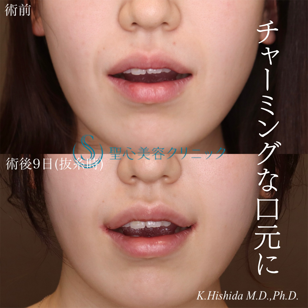【20代女性・より可愛らしい口元にしたい！！】プレミアム口角挙上術（術後9日）（抜糸時） After 