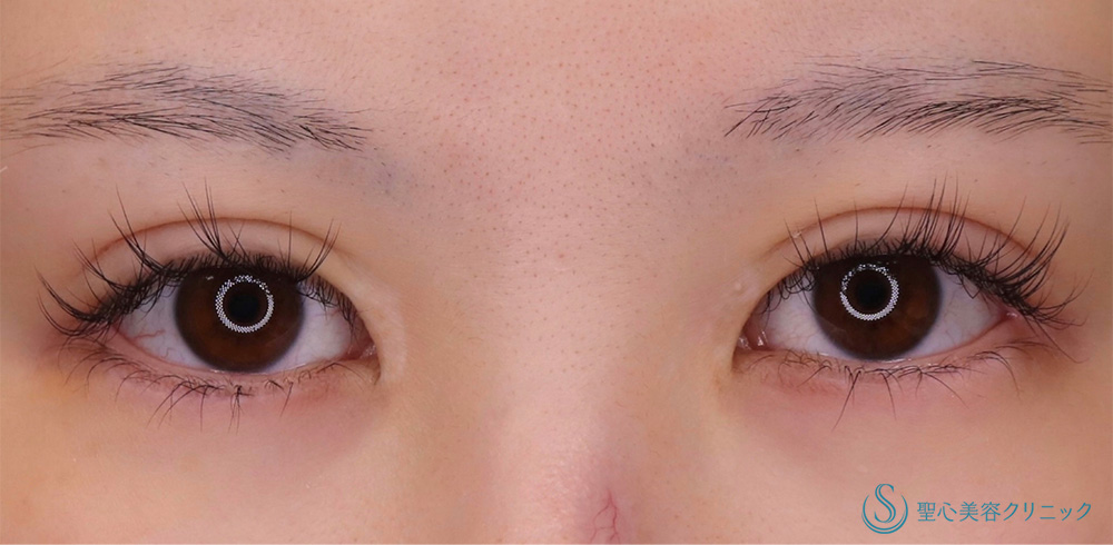 【20代女性・つり目感改善で優しい印象に】目尻切開（たれ目尻＋靭帯移動）＋眉下切開法（眉下リフト）＋睫毛上皮膚切開（5日後） Before 