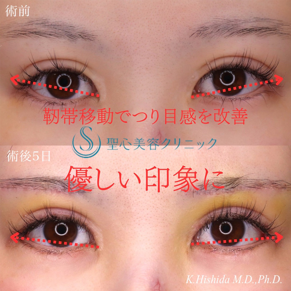 【20代女性・つり目感改善で優しい印象に】目尻切開（たれ目尻＋靭帯移動）＋眉下切開法（眉下リフト）＋睫毛上皮膚切開（5日後） After 