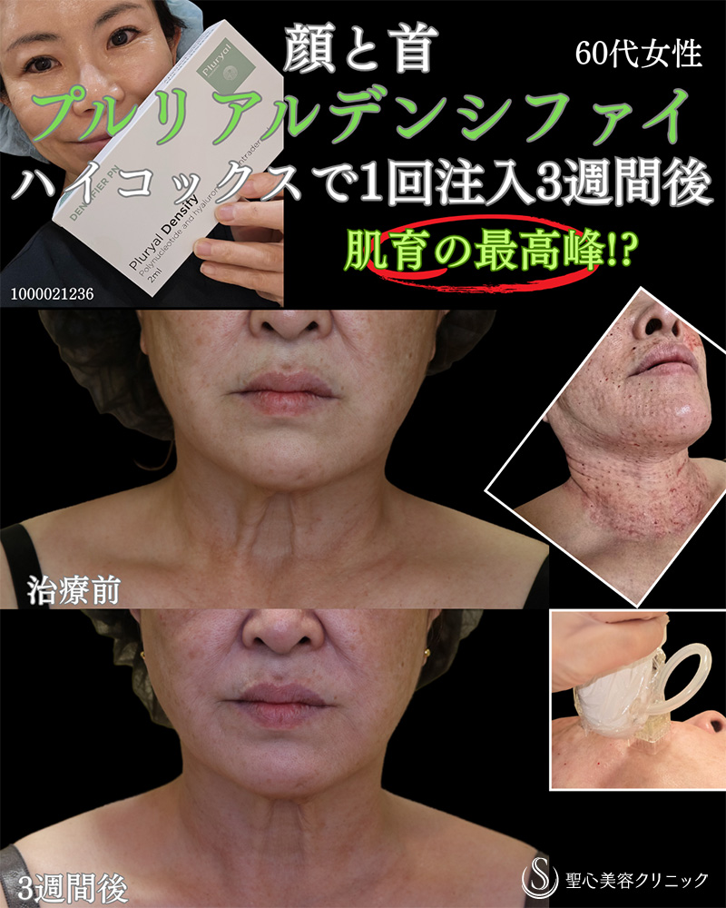 【60代女性・顔だけでなく首も肌育】プルリアルデンシファイ（3週間後） After 