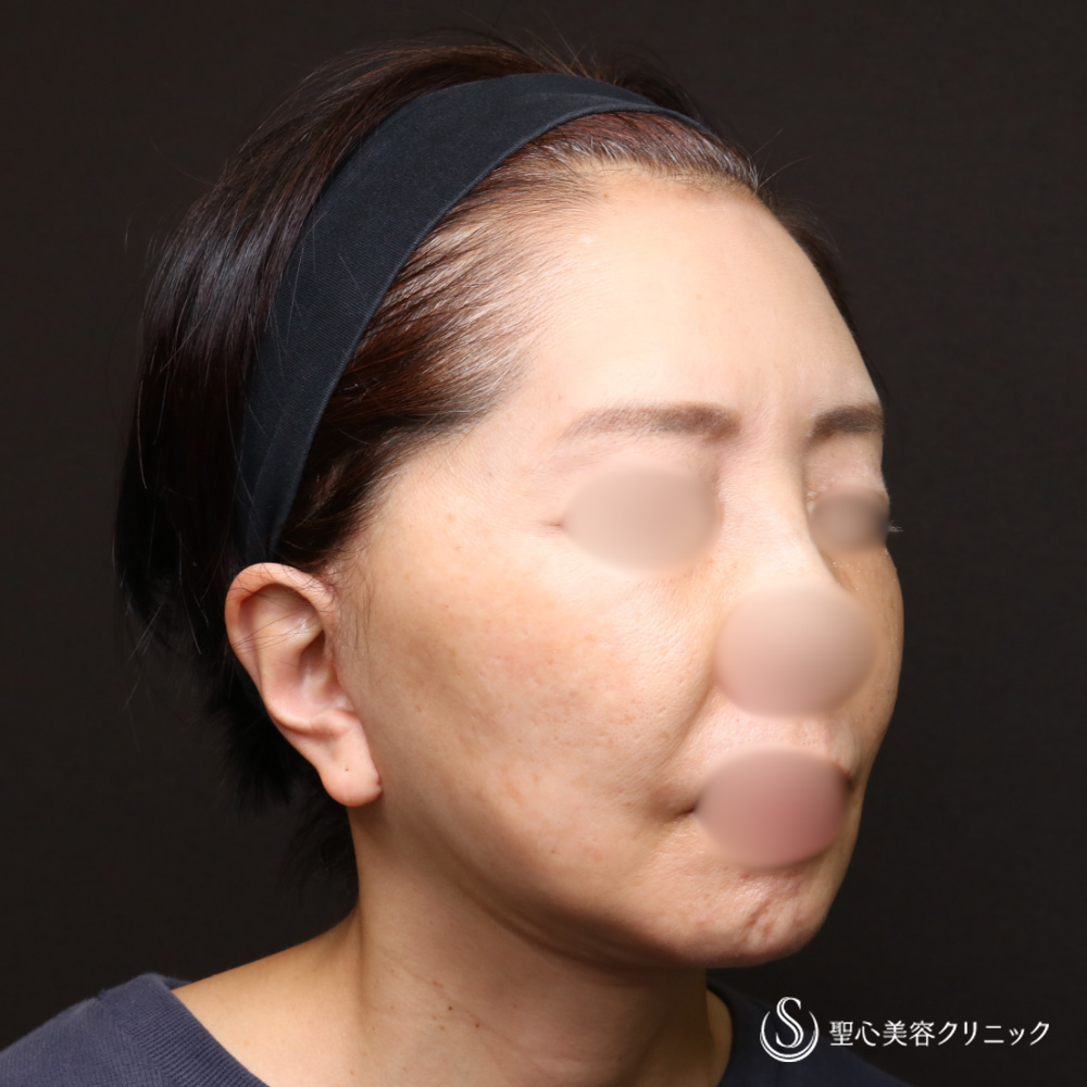 【60代女性・抜群の若返り効果】フェイスリフト＋顎下、頬の脂肪吸引＋リガメント処置（4週間後） After 