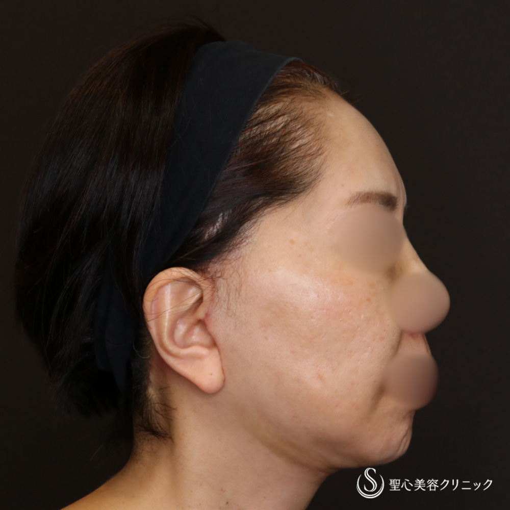 【60代女性・抜群の若返り効果】フェイスリフト＋顎下、頬の脂肪吸引＋リガメント処置（4週間後） After 