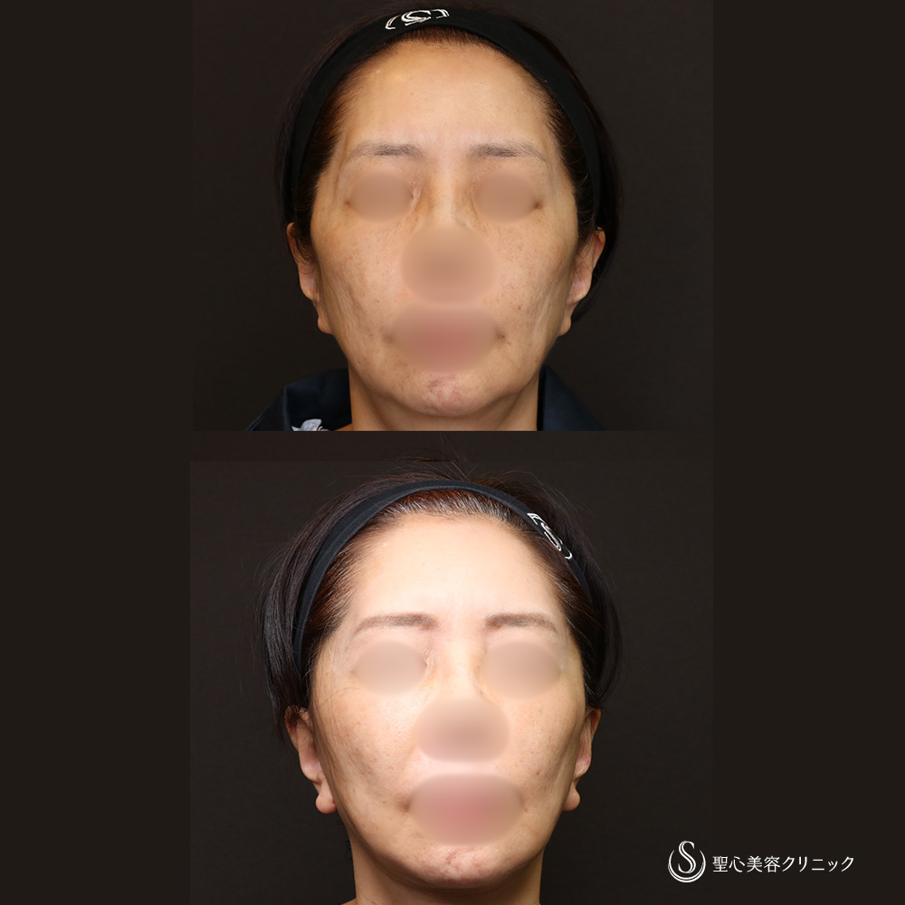 【60代女性・抜群の若返り効果】フェイスリフト＋顎下、頬の脂肪吸引＋リガメント処置（4週間後） After 名古屋院