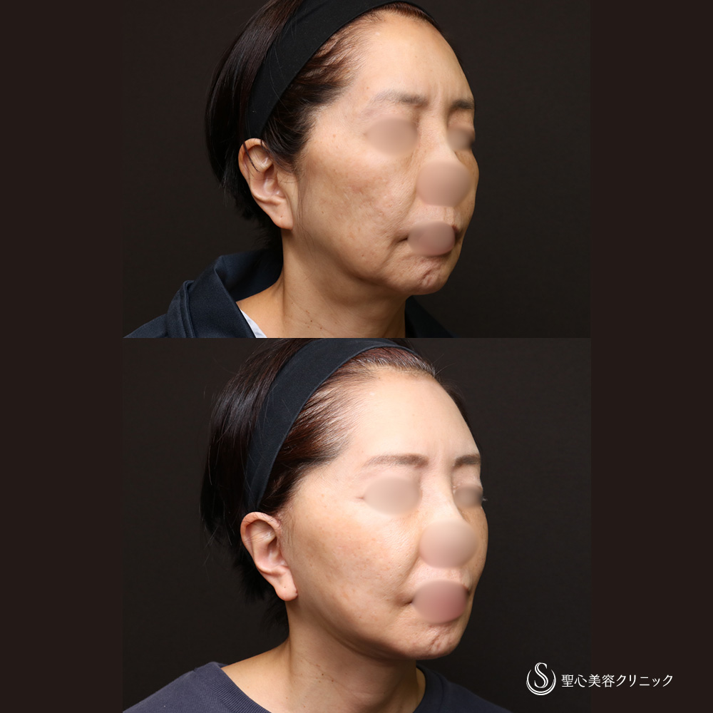 【60代女性・抜群の若返り効果】フェイスリフト＋顎下、頬の脂肪吸引＋リガメント処置（4週間後） After 名古屋院