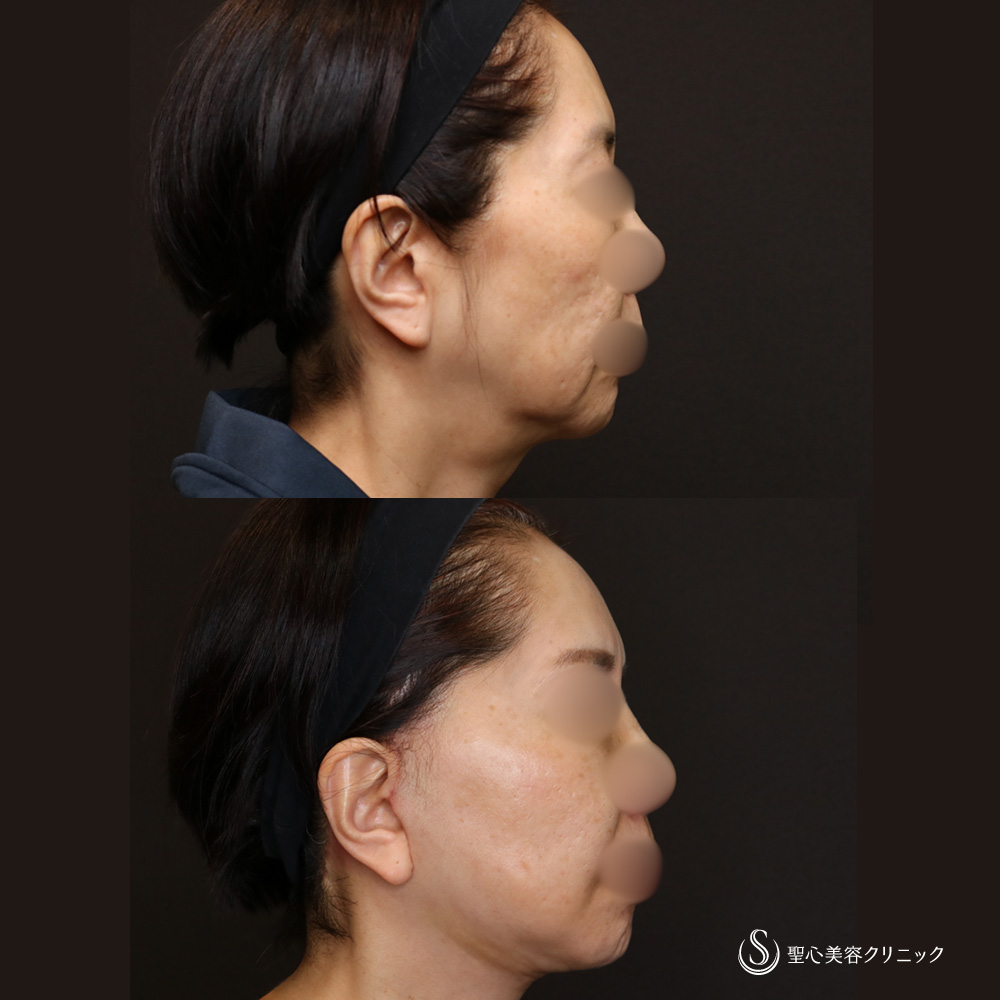 【60代女性・抜群の若返り効果】フェイスリフト＋顎下、頬の脂肪吸引＋リガメント処置（4週間後） After 名古屋院