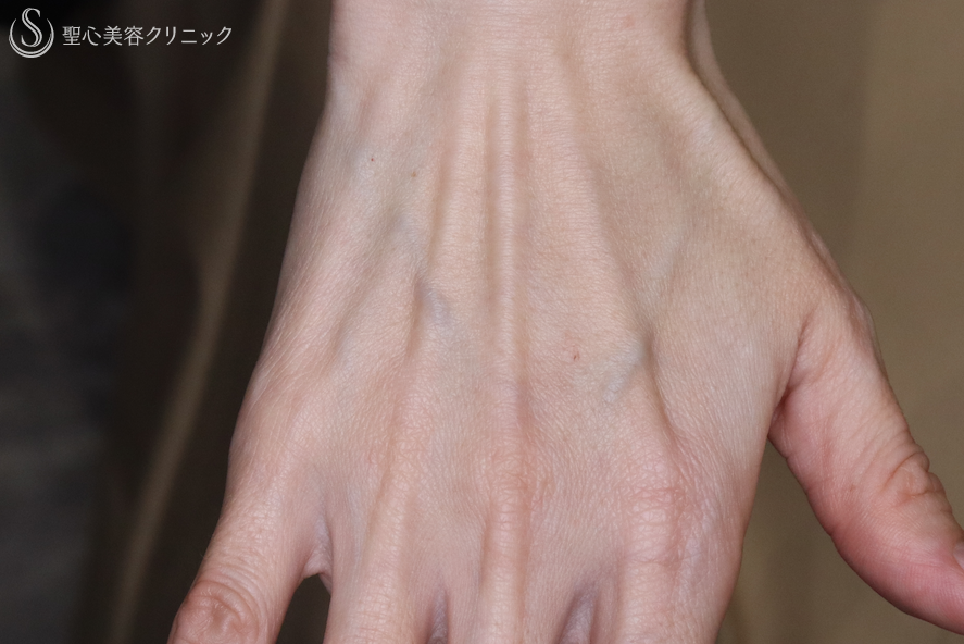 【40代女性・手の甲の若返り】プレミアムPRP皮膚再生療法（2年6ヶ月後） Before 