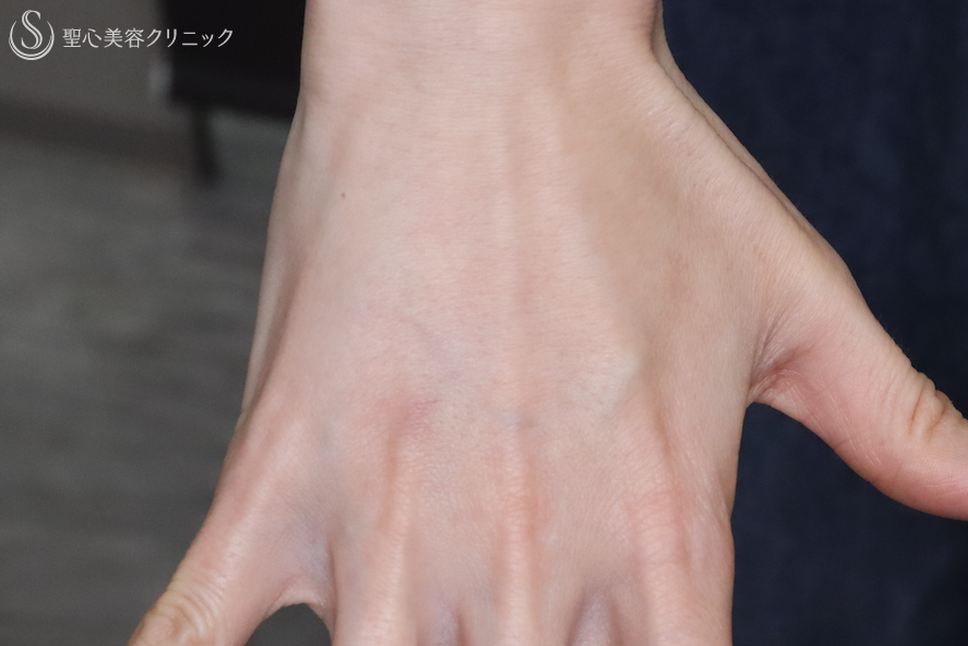 【40代女性・手の甲の若返り】プレミアムPRP皮膚再生療法（2年6ヶ月後） After 