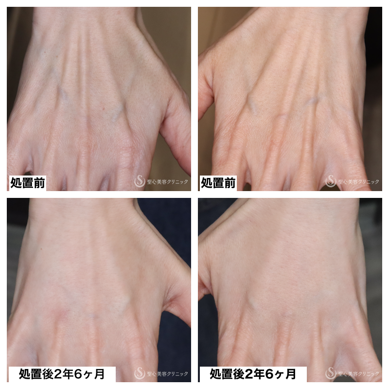 【40代女性・手の甲の若返り】プレミアムPRP皮膚再生療法（2年6ヶ月後） After 