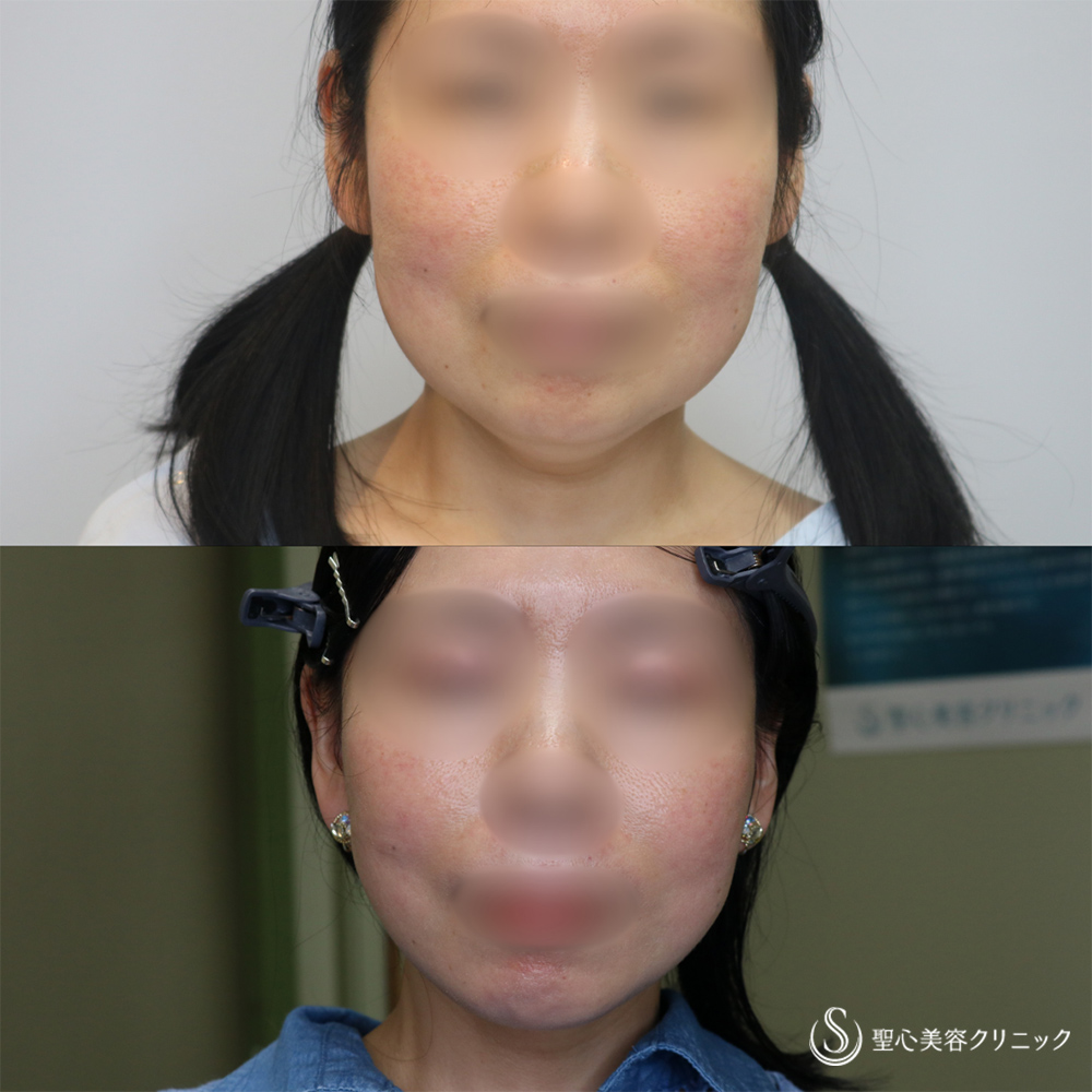 【40代女性・長期的な持続効果】フェイスリフト＋脂肪吸引（頬＋顎下）（1ヶ月・6ヶ月後） After 名古屋院