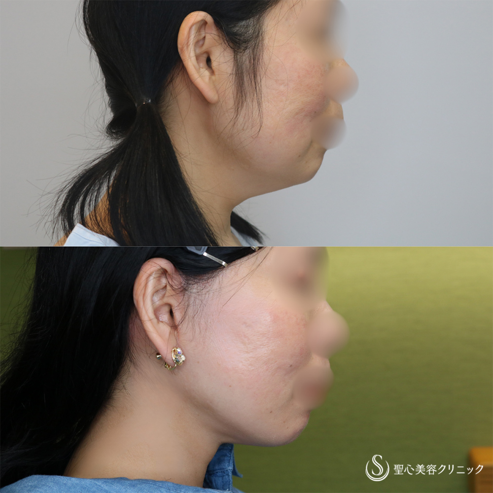 【40代女性・長期的な持続効果】フェイスリフト＋脂肪吸引（頬＋顎下）（1ヶ月・6ヶ月後） After 名古屋院