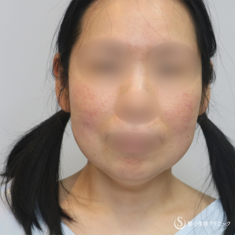 【40代女性・長期的な持続効果】フェイスリフト＋脂肪吸引（頬＋顎下）（1ヶ月・6ヶ月後） Before 