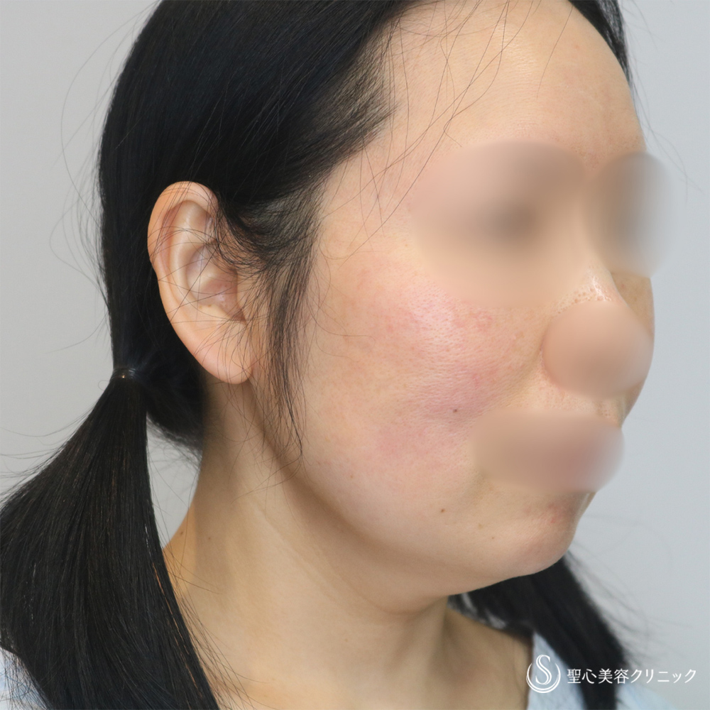 【40代女性・長期的な持続効果】フェイスリフト＋脂肪吸引（頬＋顎下）（1ヶ月・6ヶ月後） Before 