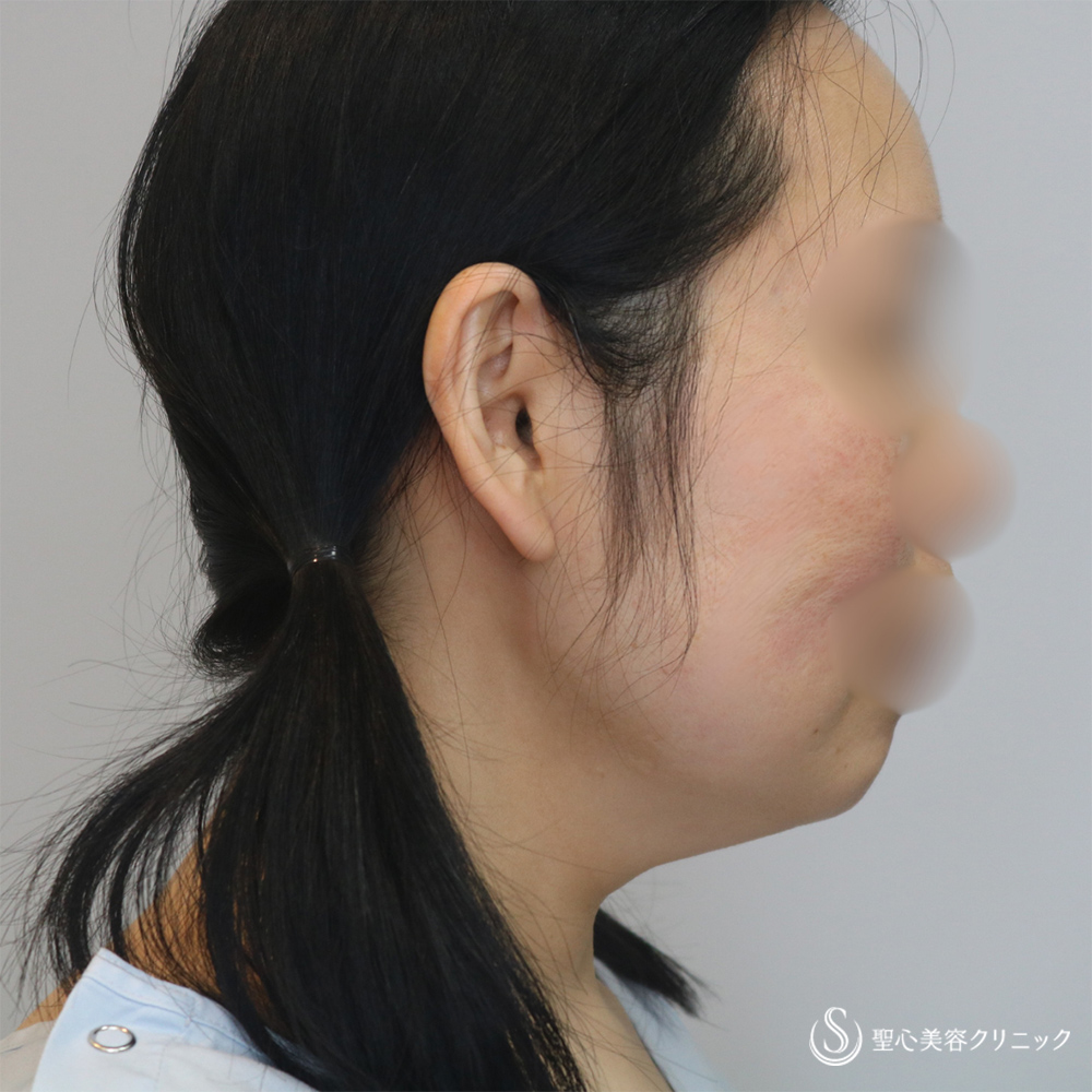 【40代女性・長期的な持続効果】フェイスリフト＋脂肪吸引（頬＋顎下）（1ヶ月・6ヶ月後） Before 