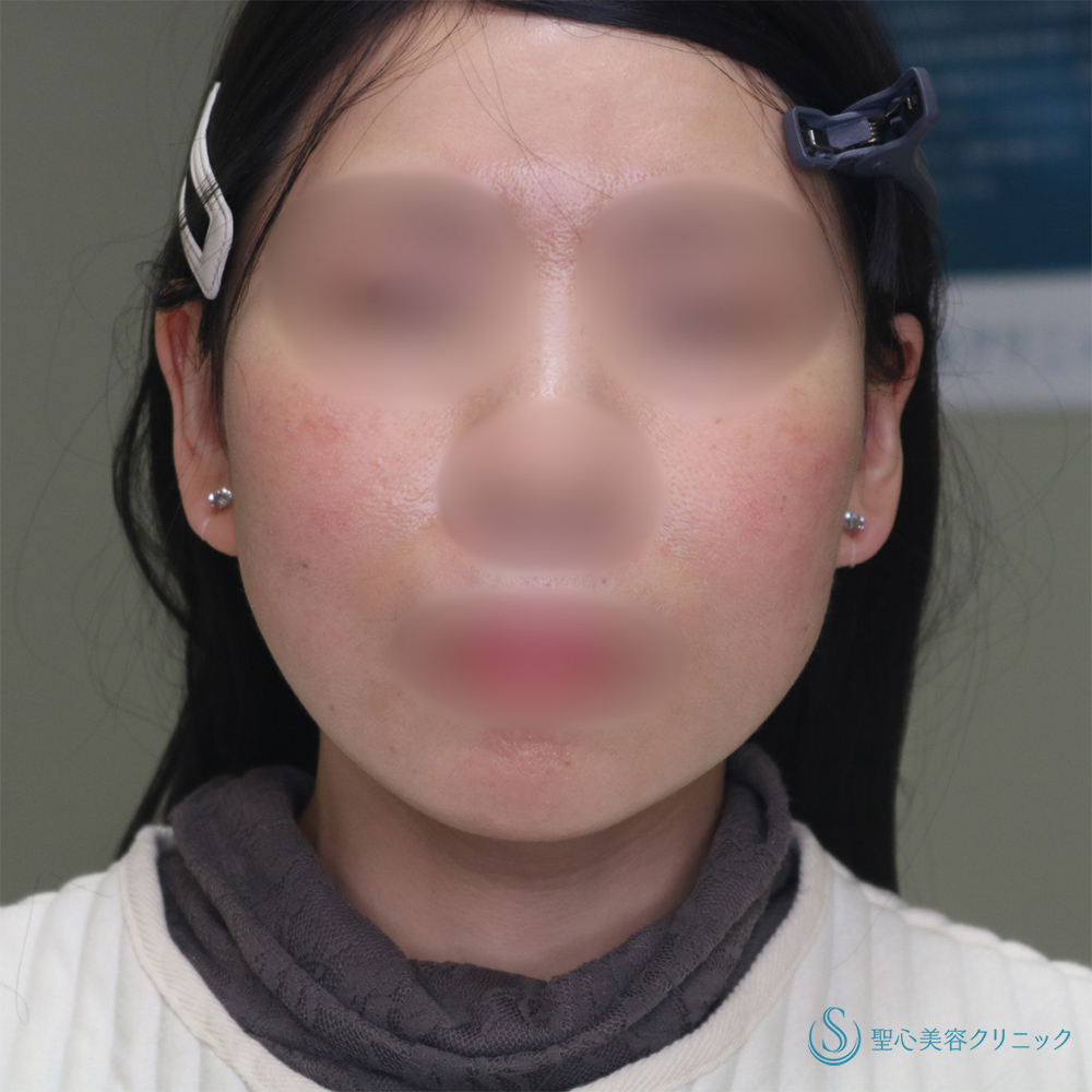 【40代女性・長期的な持続効果】フェイスリフト＋脂肪吸引（頬＋顎下）（1ヶ月・6ヶ月後） After 