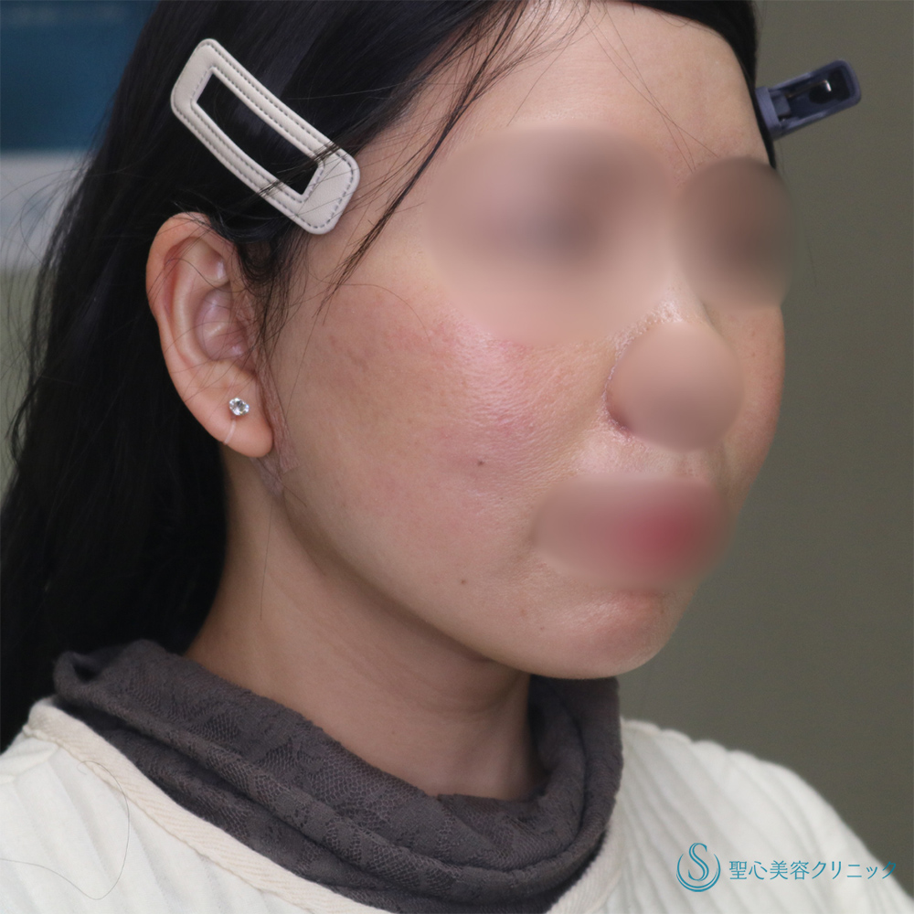 【40代女性・長期的な持続効果】フェイスリフト＋脂肪吸引（頬＋顎下）（1ヶ月・6ヶ月後） After 