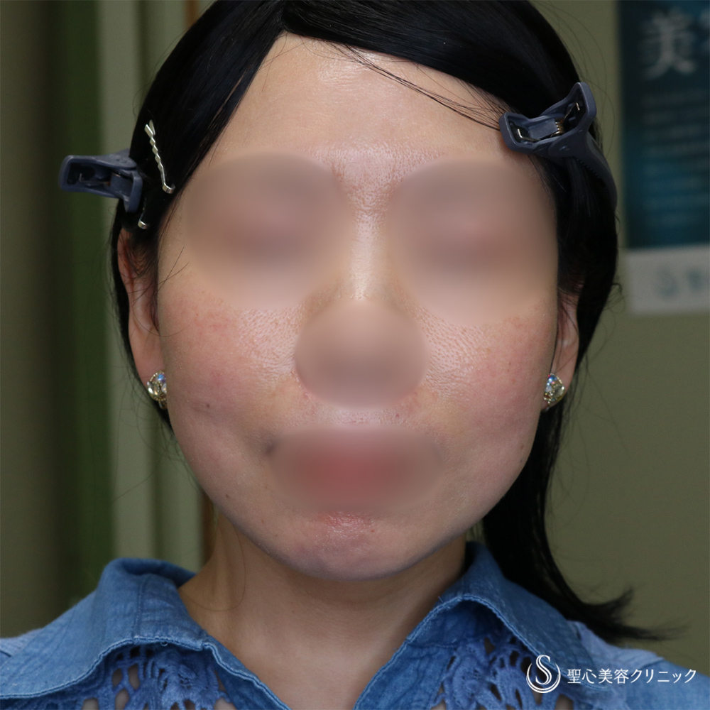 【40代女性・長期的な持続効果】フェイスリフト＋脂肪吸引（頬＋顎下）（1ヶ月・6ヶ月後） After 