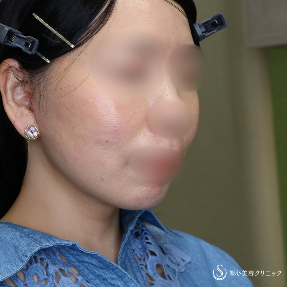 【40代女性・長期的な持続効果】フェイスリフト＋脂肪吸引（頬＋顎下）（1ヶ月・6ヶ月後） After 