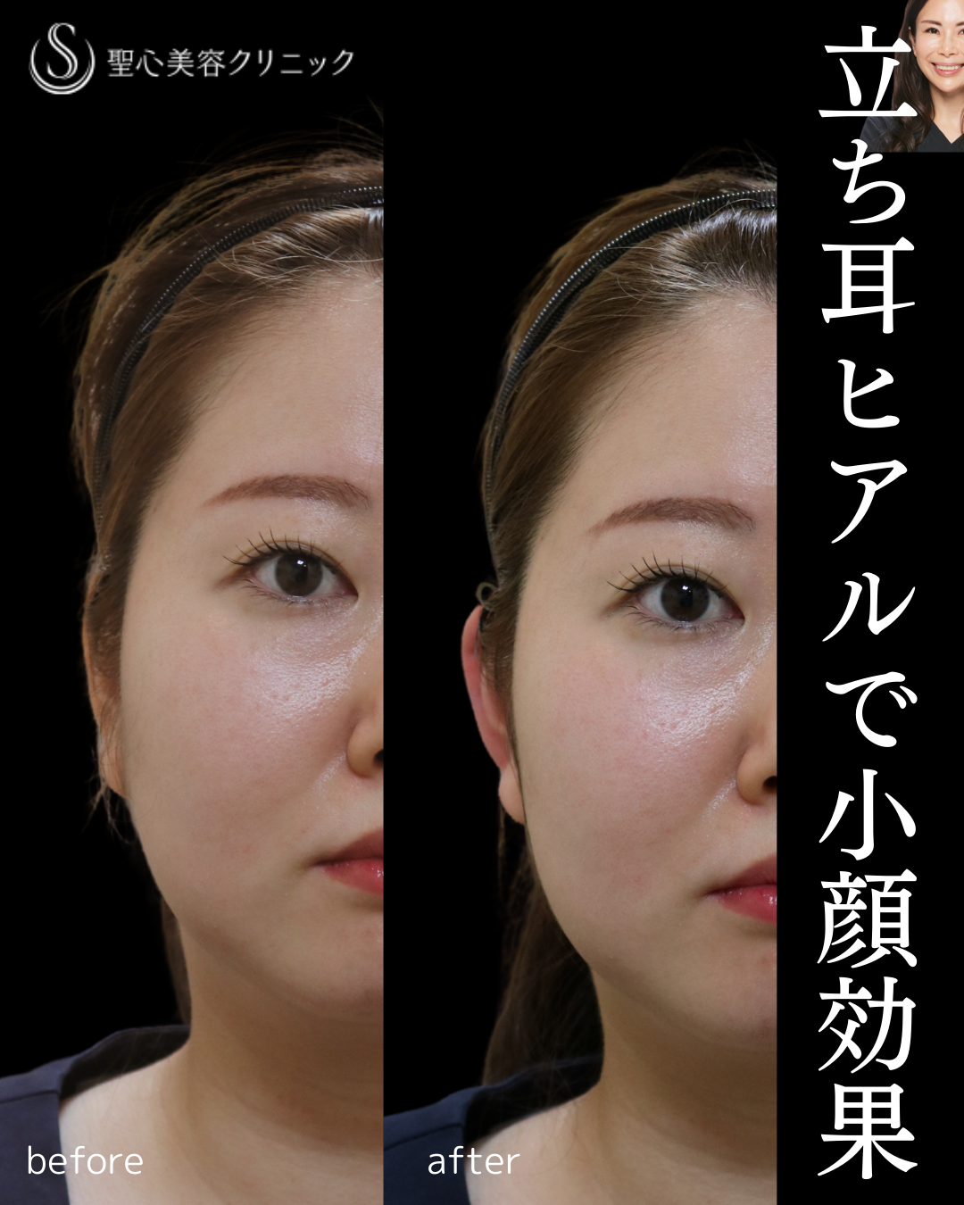 【30代女性・たち耳で小顔に】ヒアルロン酸注入（右耳に1㏄）（直後） After 