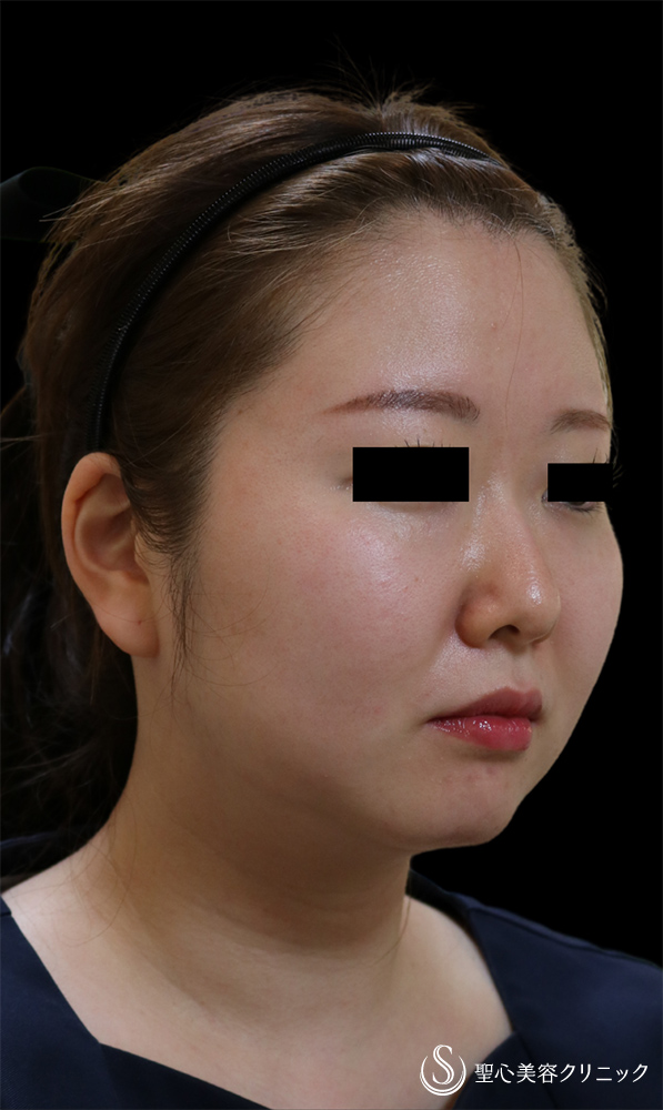 【30代女性・たち耳で小顔に】ヒアルロン酸注入（右耳に1㏄）（直後） Before 