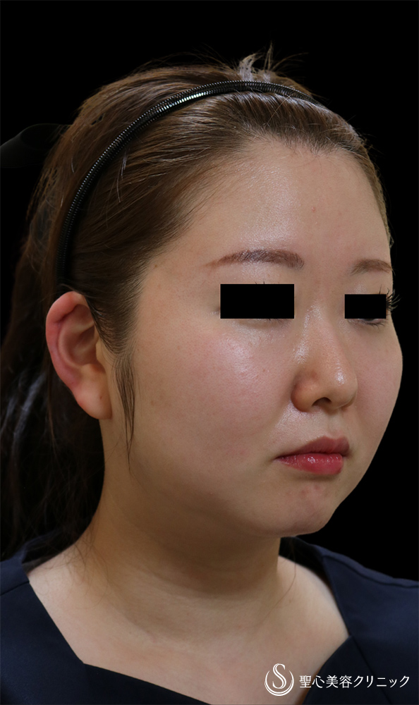 【30代女性・たち耳で小顔に】ヒアルロン酸注入（右耳に1㏄）（直後） After 