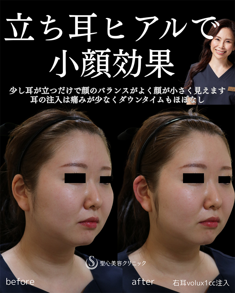 【30代女性・たち耳で小顔に】ヒアルロン酸注入（右耳に1㏄）（直後） After 