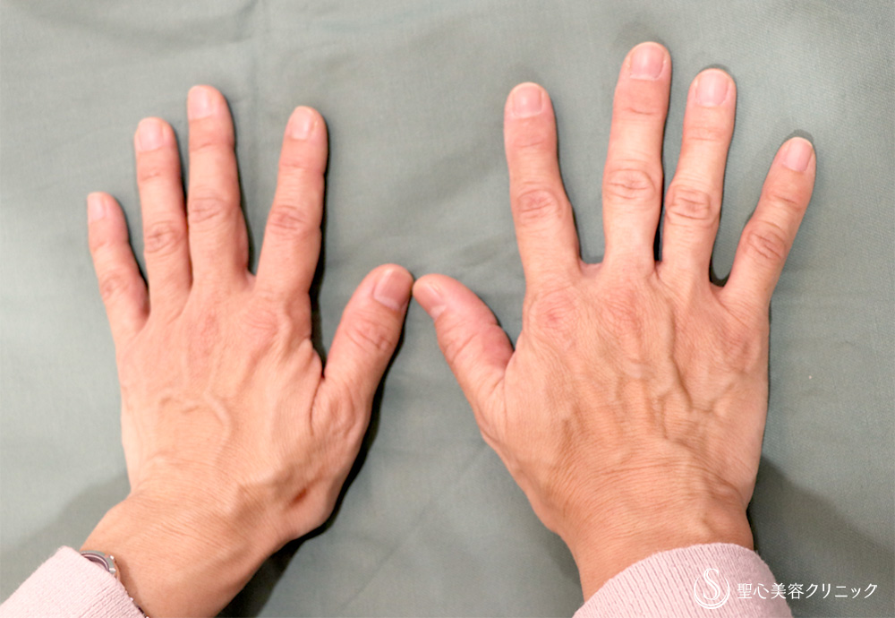 【50代女性・手の甲もふっくら改善】プレミアムPRP皮膚再生療法（半年後） Before 