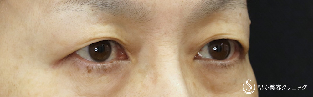 【50代女性・自然な仕上がり目元が優しい印象に】 眉下切開法（眉下リフト）（1ヶ月後） Before 