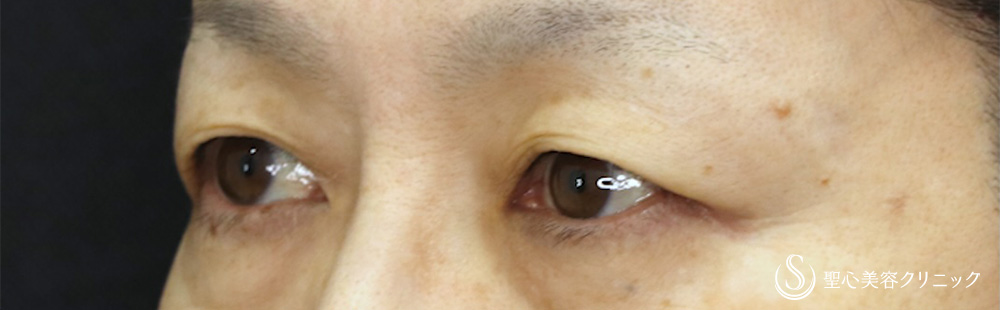 【50代女性・自然な仕上がり目元が優しい印象に】 眉下切開法（眉下リフト）（1ヶ月後） Before 