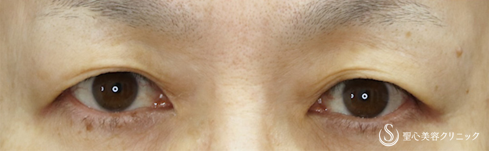 【50代女性・自然な仕上がり目元が優しい印象に】 眉下切開法（眉下リフト）（1ヶ月後） Before 