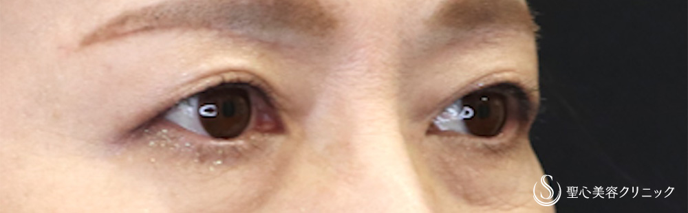 【50代女性・自然な仕上がり目元が優しい印象に】 眉下切開法（眉下リフト）（1ヶ月後） After 