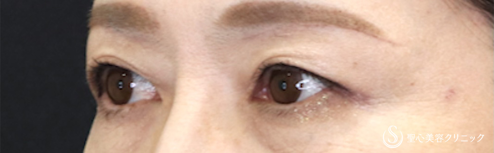 【50代女性・自然な仕上がり目元が優しい印象に】 眉下切開法（眉下リフト）（1ヶ月後） After 