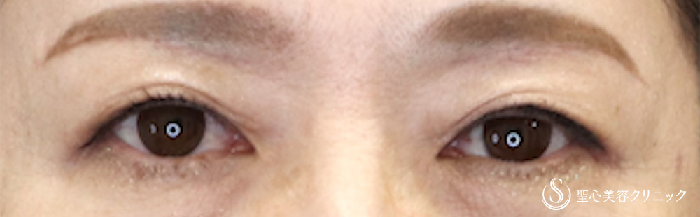 【50代女性・自然な仕上がり目元が優しい印象に】 眉下切開法（眉下リフト）（1ヶ月後） After 
