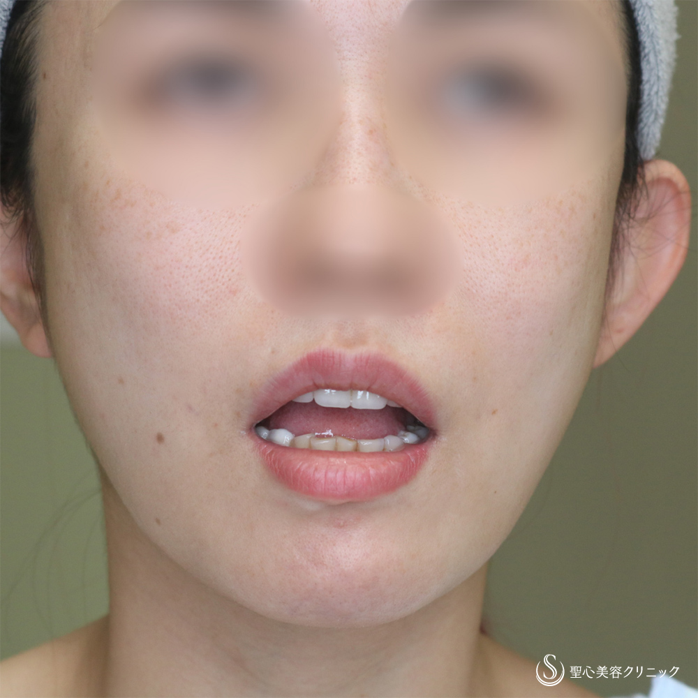 【30代女性・自然な口角アップで若返り】スマイルリップ（プレミアム口角挙上術）（1ヶ月後） Before 