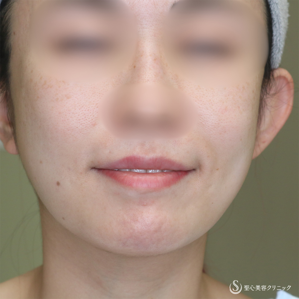 【30代女性・自然な口角アップで若返り】スマイルリップ（プレミアム口角挙上術）（1ヶ月後） Before 