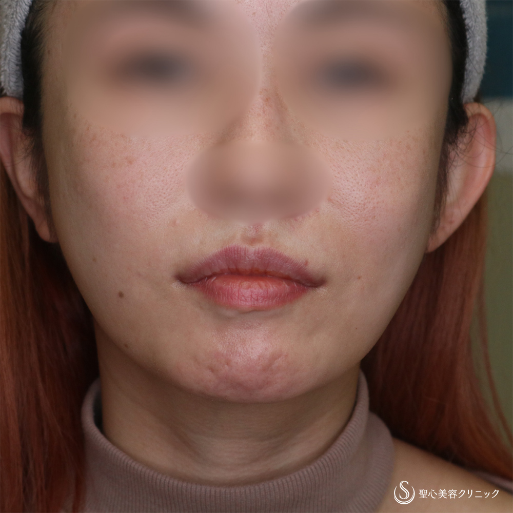 【30代女性・自然な口角アップで若返り】スマイルリップ（プレミアム口角挙上術）（1ヶ月後） After 
