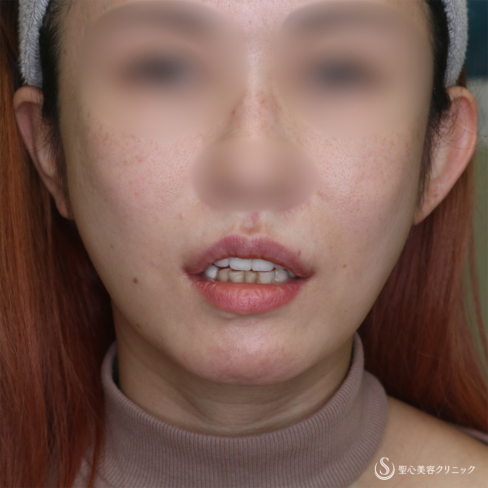 【30代女性・自然な口角アップで若返り】スマイルリップ（プレミアム口角挙上術）（1ヶ月後） After 