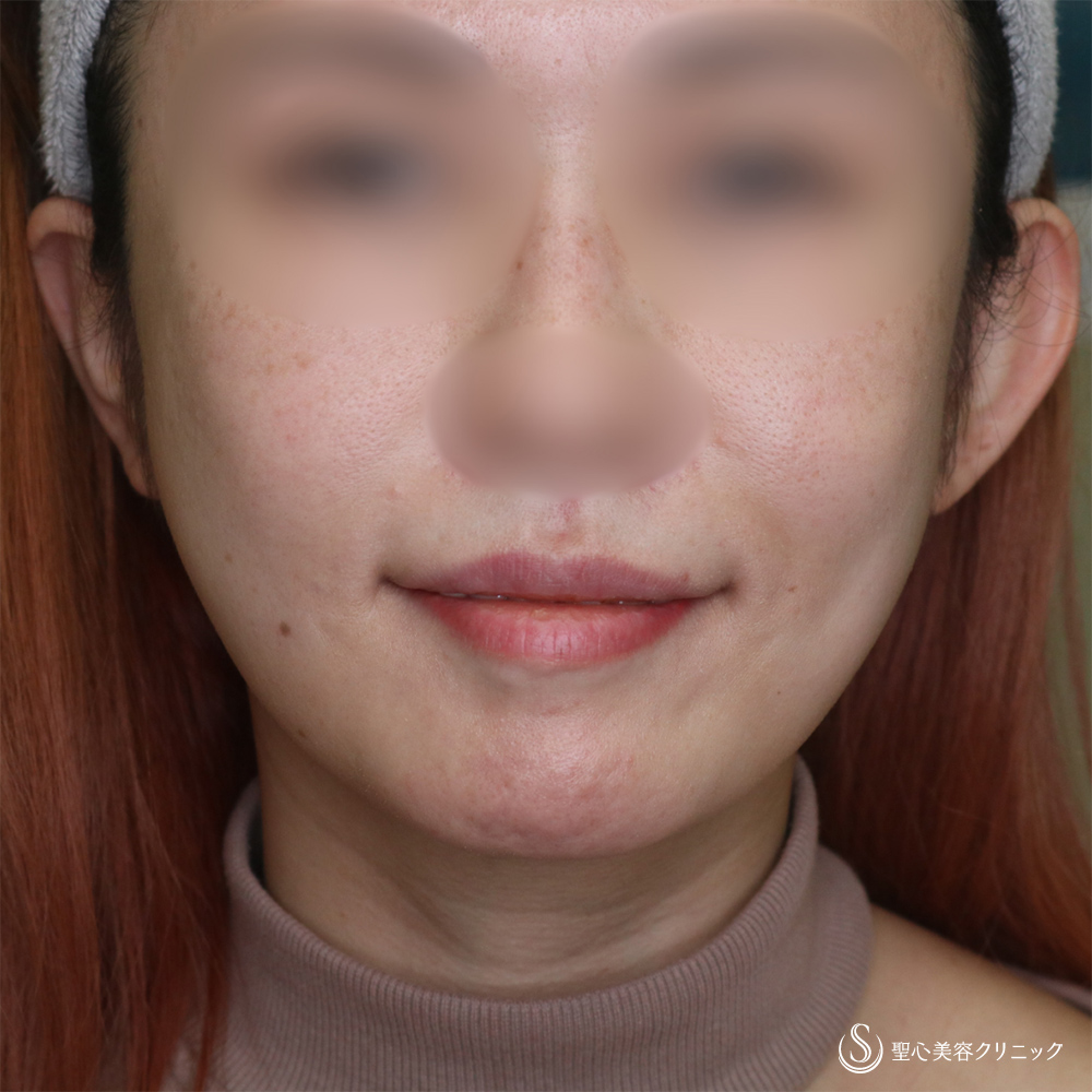 【30代女性・自然な口角アップで若返り】スマイルリップ（プレミアム口角挙上術）（1ヶ月後） After 